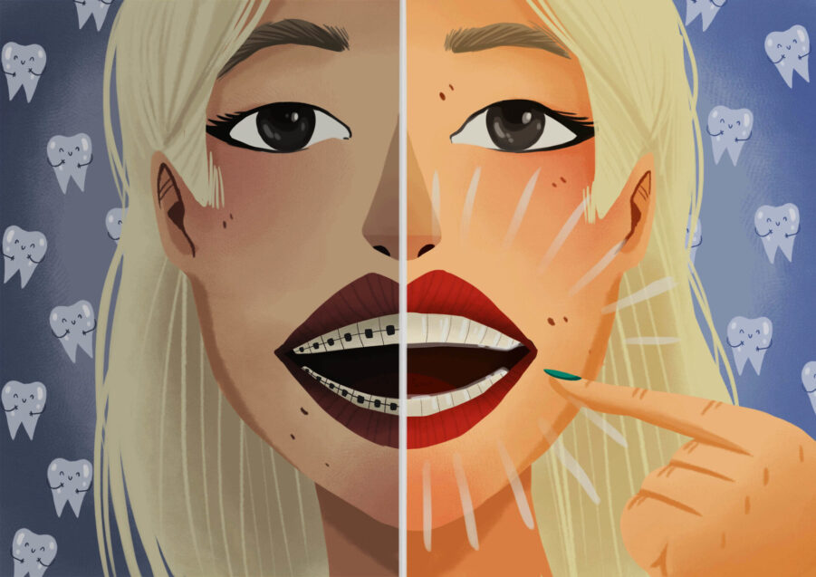 Graphic illustration of woman smiling comparing Invisalign clear aligners vs traditional braces
